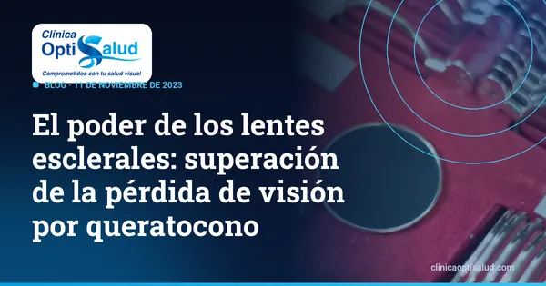 El poder de los lentes esclerales: superación de la pérdida de visión por queratocono