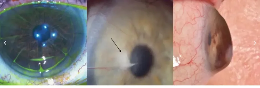 Complicaciones de Lasik