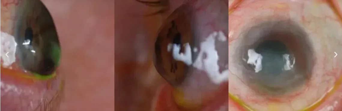 Ectasia Corneal