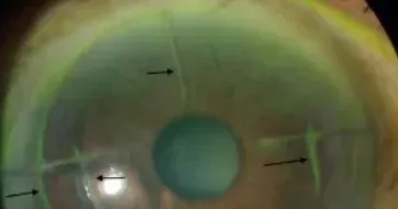 Complicaciones de Lasik