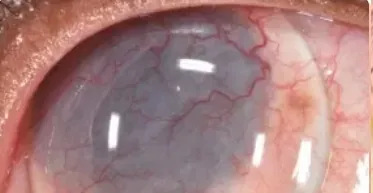 Distrofia y Degeneración Corneal