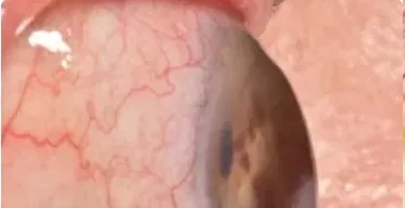 Ectasia Corneal