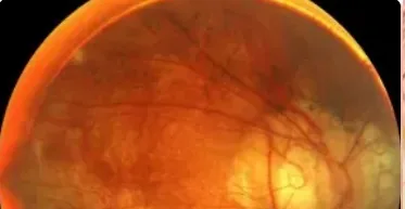 Manejo de Miopía