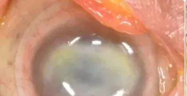 Síndrome del Ojo Seco
