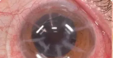 Complicaciones de la Queratotomía Radial