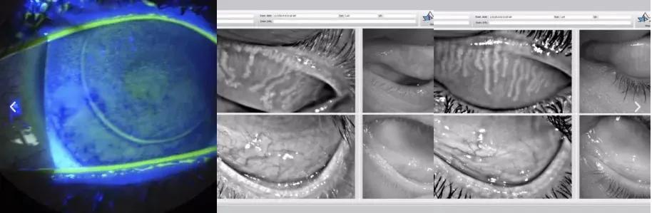 Lente escleral EyePrintPRO adaptado en Clínica OptiSalud, Nicaragua